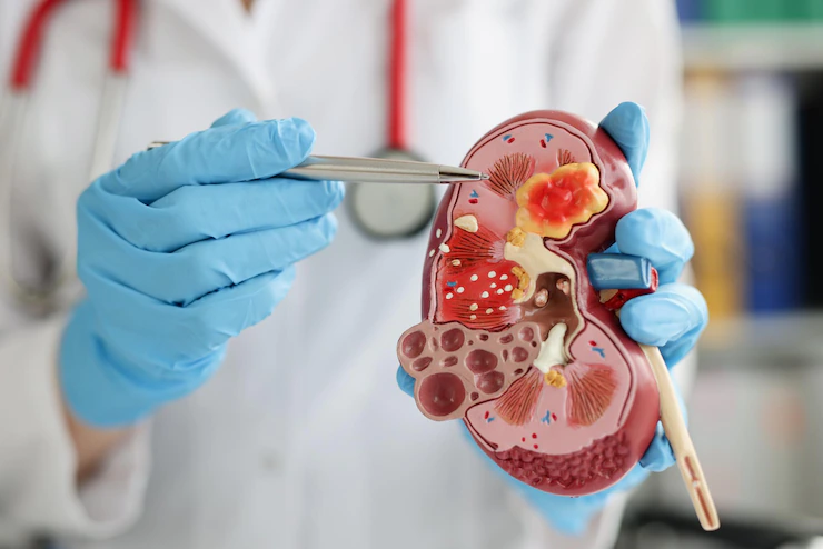 10 Thing to consider when choosing a Nephrologist (Kidney Specialist) in South Africa