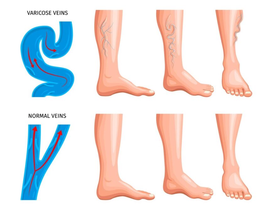 10 Ways To Manage Varicose Veins - Health